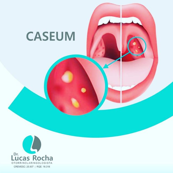 Caseum- Você sabe o que é? - Dr. Lucas Rocha